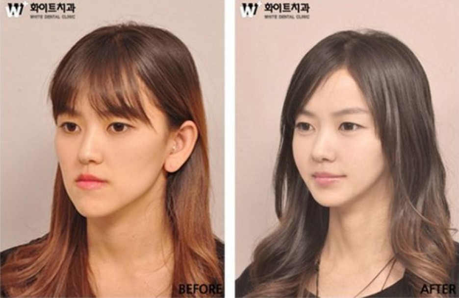 Другое лицо: до и после чуда корейской пластической хирургии.