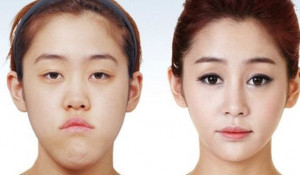 Пластическая хирургия в Южной Корее. До и после.