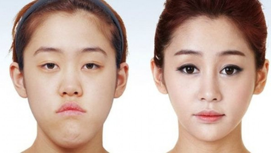 Пластическая хирургия в Южной Корее. До и после.