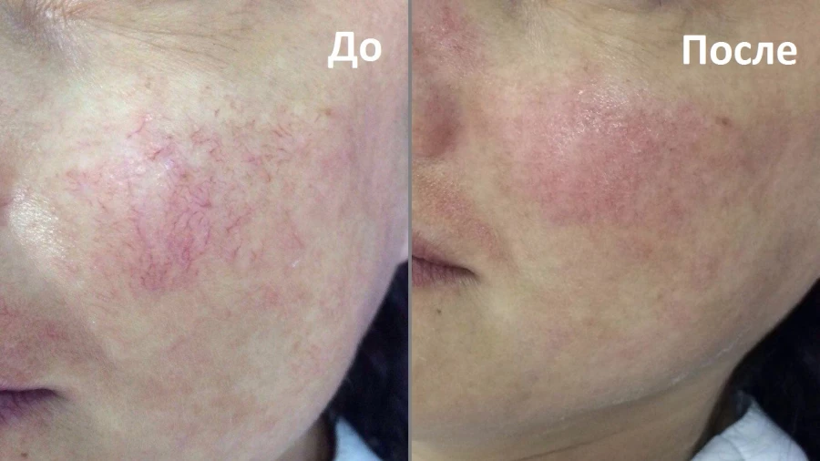 Сосудистые звездочки на щеке.