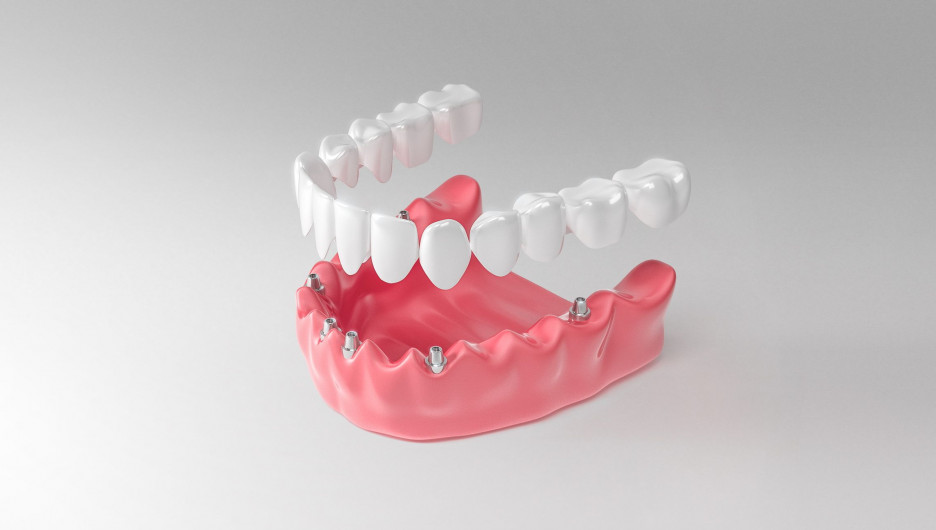 Имплантация зубов без костной пластики по протоколу немедленной нагрузки.