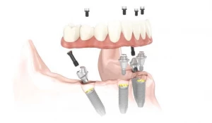 Уникальная технология по восстановлению зубов.