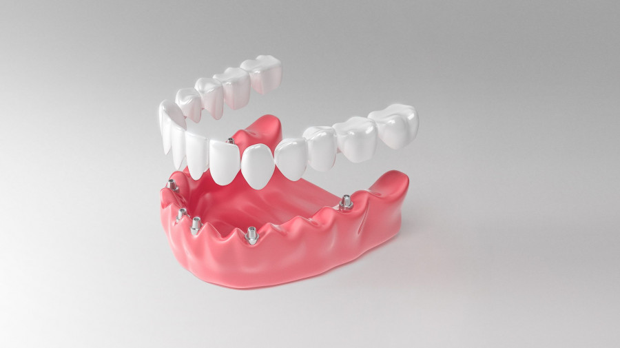 Имплантация зубов без костной пластики по протоколу немедленной нагрузки.