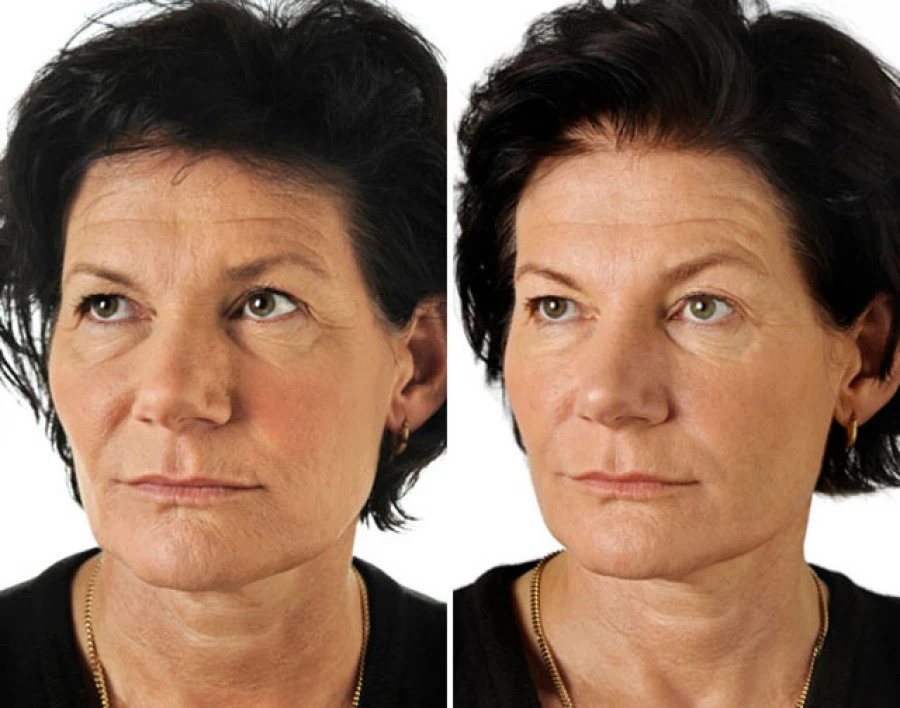 Биоревитализация лица до и после эффект фото до 40 лет