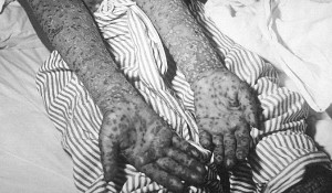 Пациент с оспой, эпидемия Косово, Югославия, март и апрель 1972 года