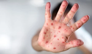 Вспышка кори.