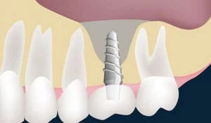 Зубное протезирование
