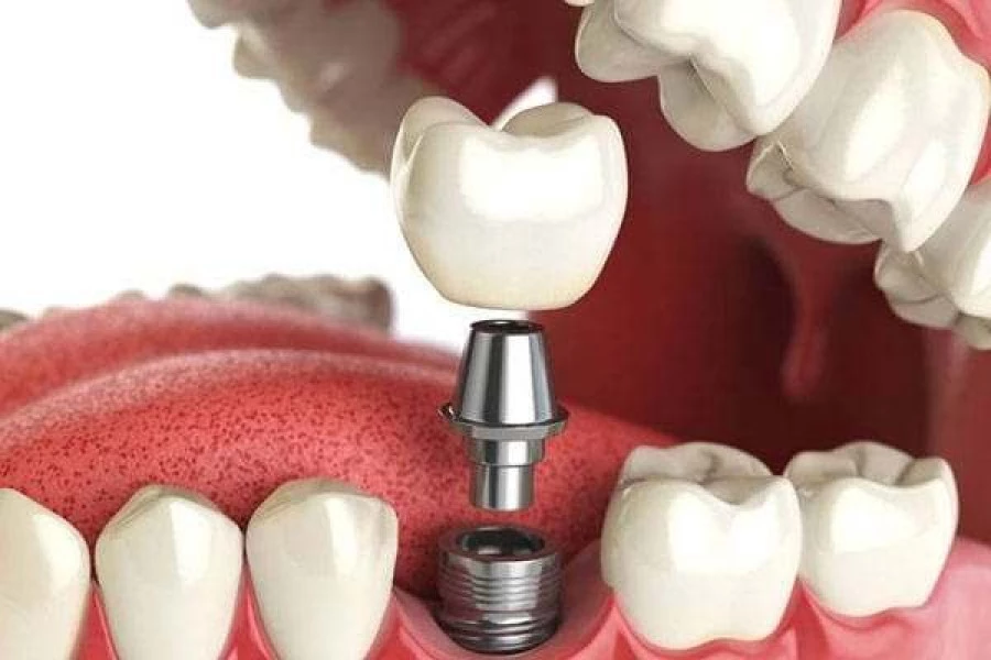 Зубное протезирование