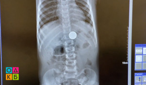 Ребенок проглотил монету. Рентген.