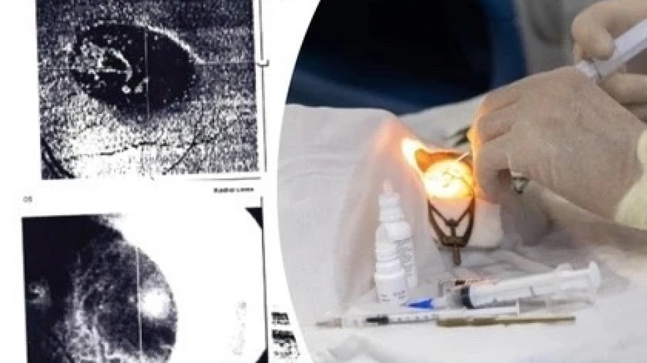 Пенсионерка судится с новосибирскими врачами из-за ампутации глаза 