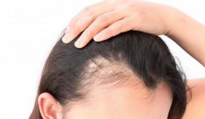 Алопеция — это патологическая потеря волос, обусловленная различными факторами.