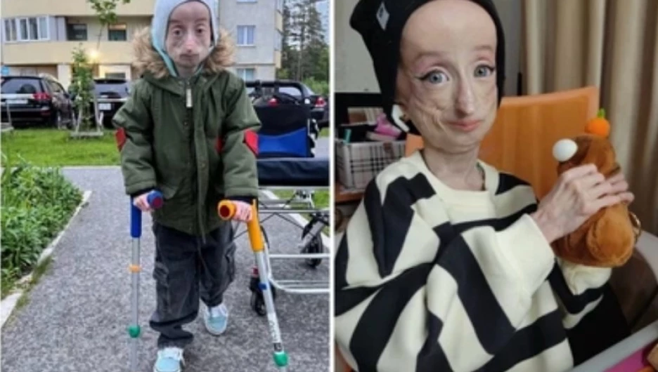 Стало известно, как живет 15-летняя девочка-Добби с прогерией