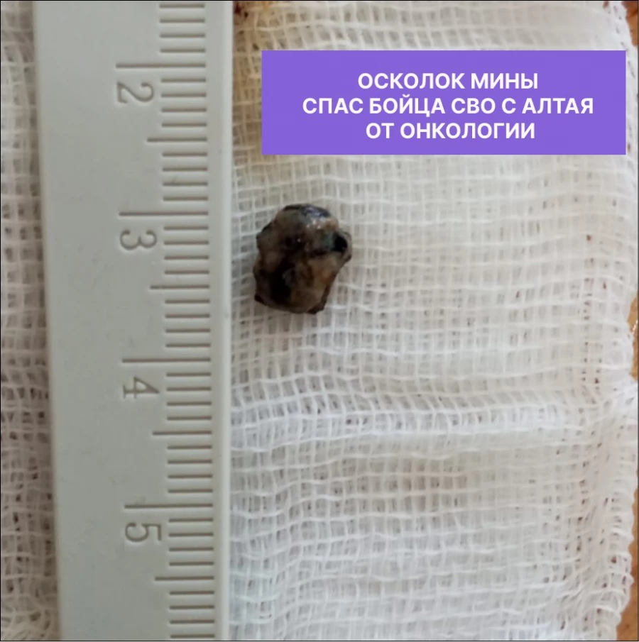 Осколок мины спас жителя Алтайского края от рака легкого