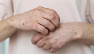 Сыпь. Кожные заболевания.