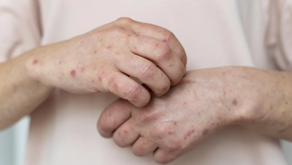 Сыпь. Кожные заболевания.