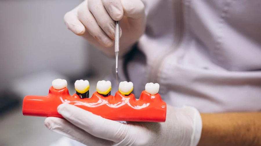 Зубной имплант.