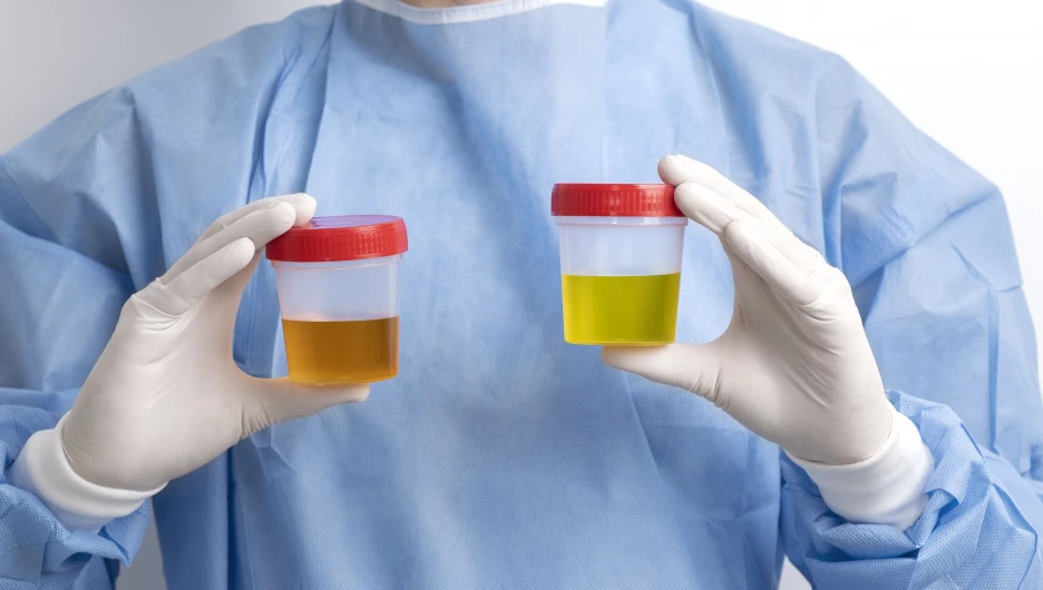 Анализ мочи.