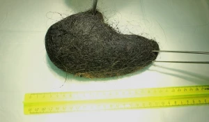 Комок волос, который извлекли из девочки 