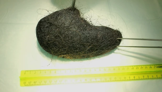 Комок волос, который извлекли из девочки 