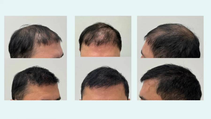 Безоперационная пересадка волос в клинике «НАНОБЬЮТИ»: до и после.