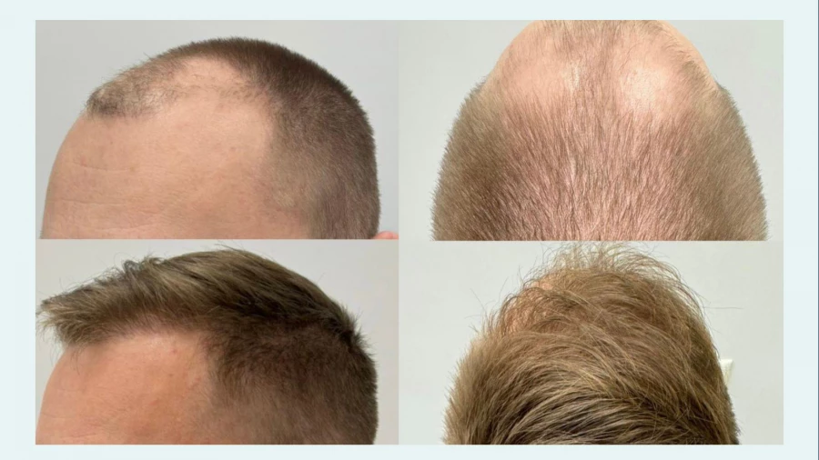 Безоперационная пересадка волос в клинике «НАНОБЬЮТИ»: до и после.