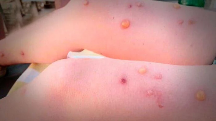 укусы тигровых комаров