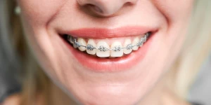 Улыбающаяся женщина с брекетами.