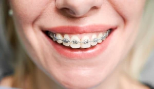 Улыбающаяся женщина с брекетами.