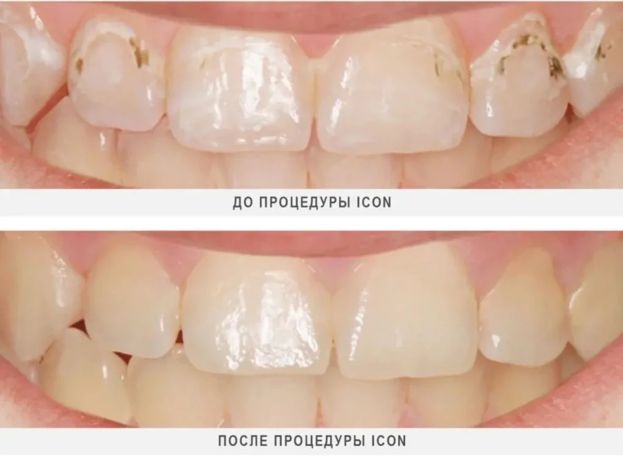 ICON — метод лечения начального кариеса.